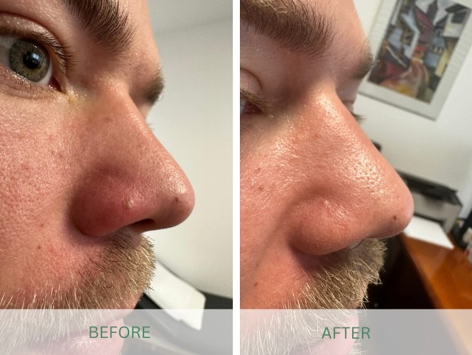 Tore-before-after